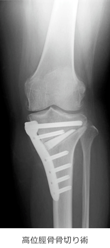 高位脛骨骨切り術