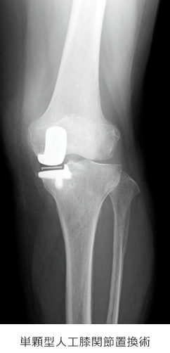 単類型人口膝関節置換術