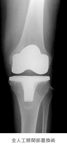 全人工膝関節置換術