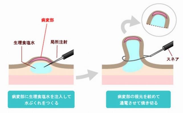 EMRの手技