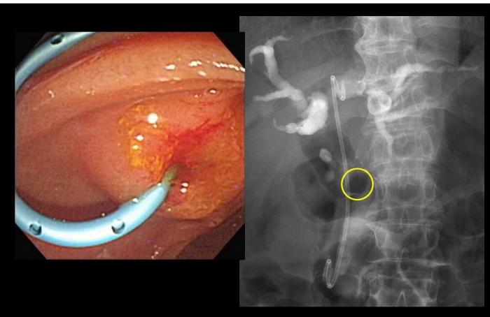 内視鏡的胆道ドレナージ術(ERBD)