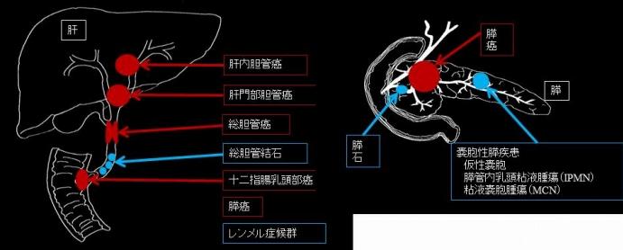 ERCPの適応となる主な疾患