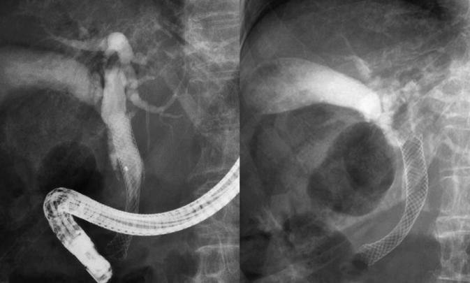 内視鏡的胆道ステント(金属ステントEMS)留置術(EBL)