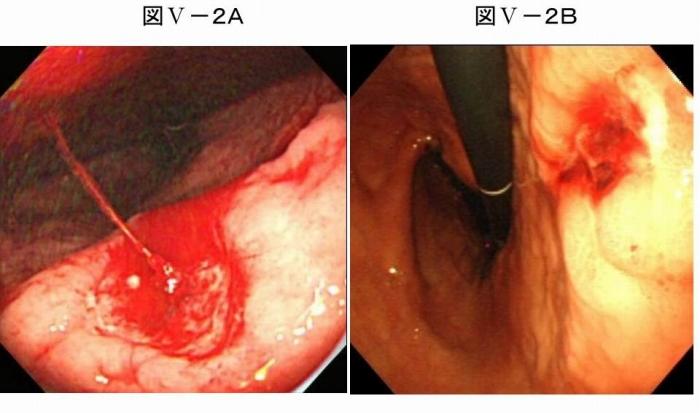 胃潰瘍からの活動性出血