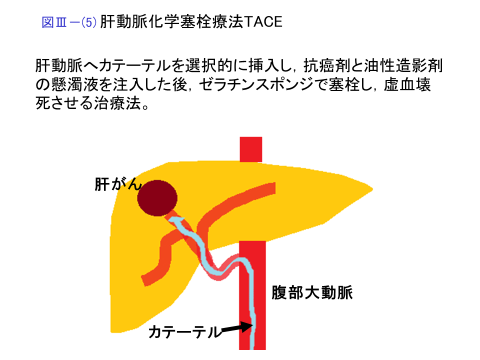 肝動脈化学塞栓療法（TACE）