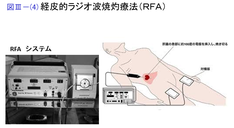 経皮的ラジオ波焼灼療法（RFA）