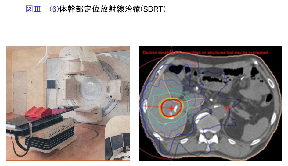 体幹部定位放射線治療（SBRT）