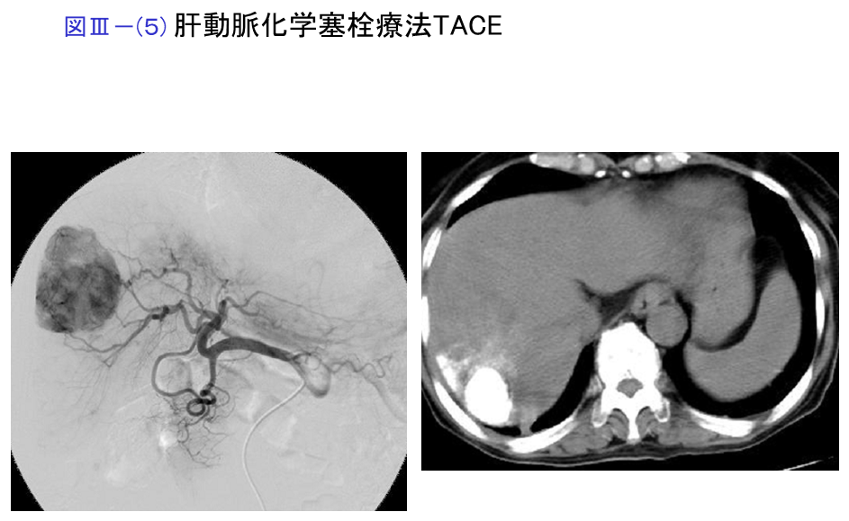 肝動脈化学塞栓療法（TACE）