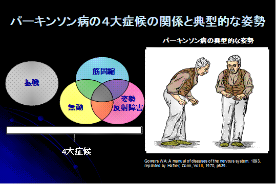 パーキンソン病の4大症候の関係と典型的な姿勢