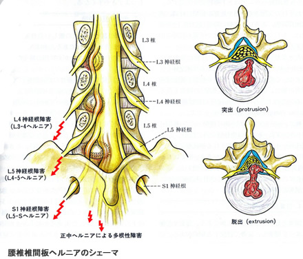 腰椎椎間板ヘルニア