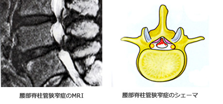 腰部脊柱管狭窄症