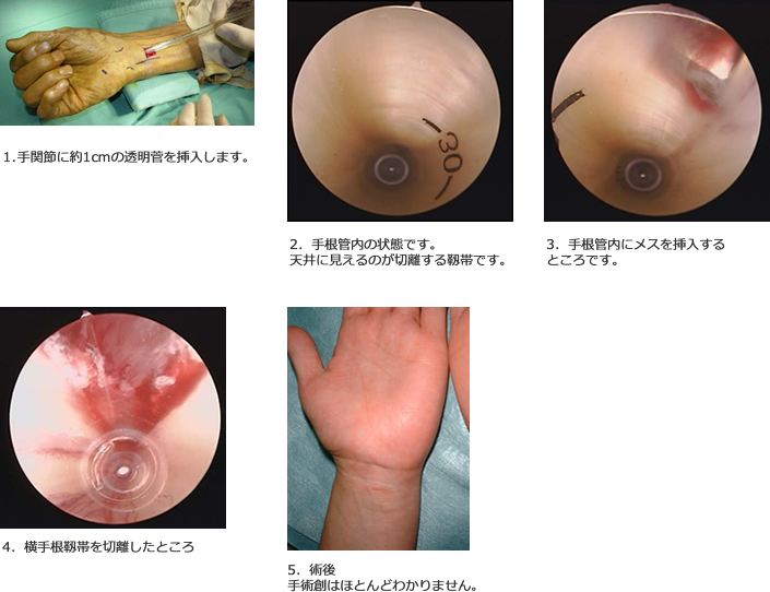 手根管内視鏡手術の実際の画像