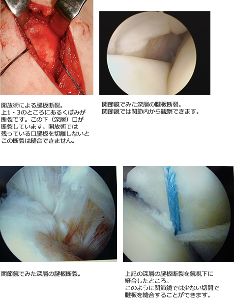 腱板断裂の関節鏡視下手術の画像