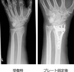 橈骨遠位端骨折