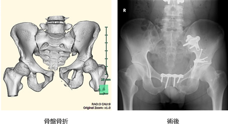 骨盤骨折