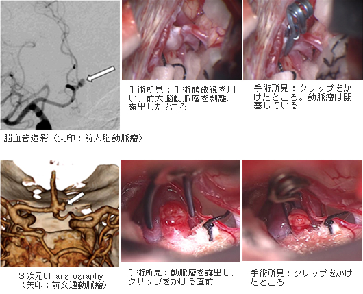 未破裂脳動脈瘤